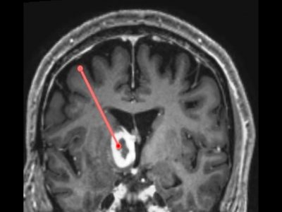 Stereotactic biopsies