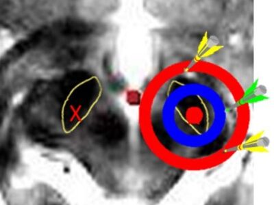 Accurracy and misplaced electrodes