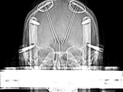 DBS implantations – Variations, replacements and revisions